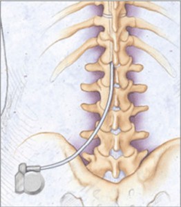 Eletrodo de Estimulação Medular.