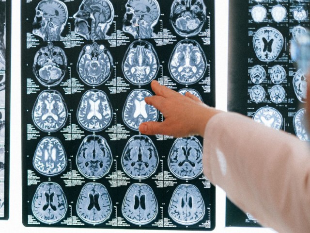 Inteligência Artificial prevê Alzheimer com quase 100% de precisão