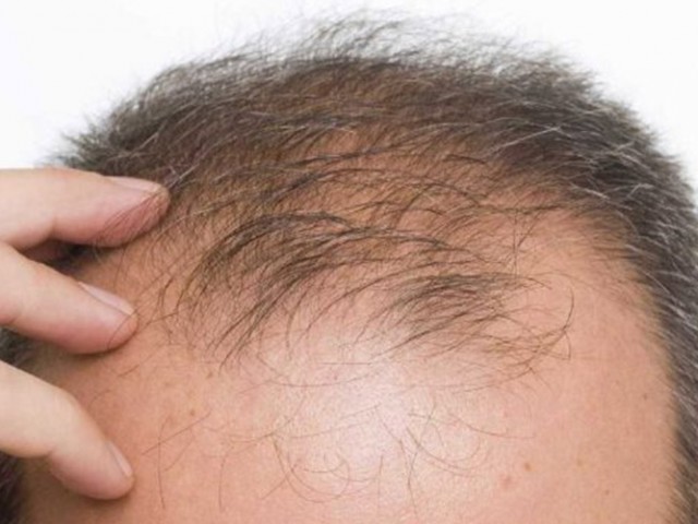Cabelo a partir de células-tronco renasce como cabelo natural